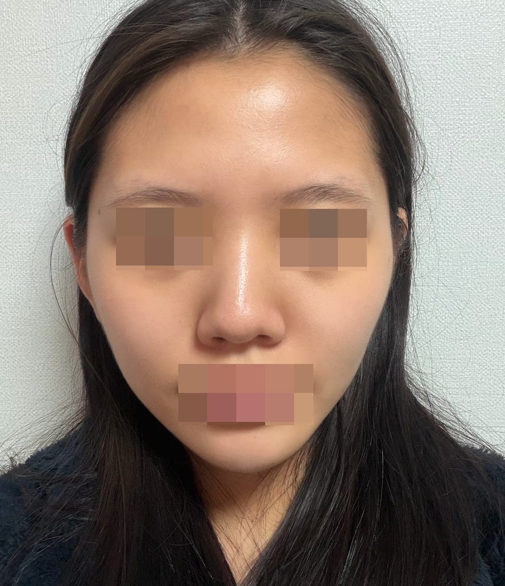 Tip plasty with own cartilage