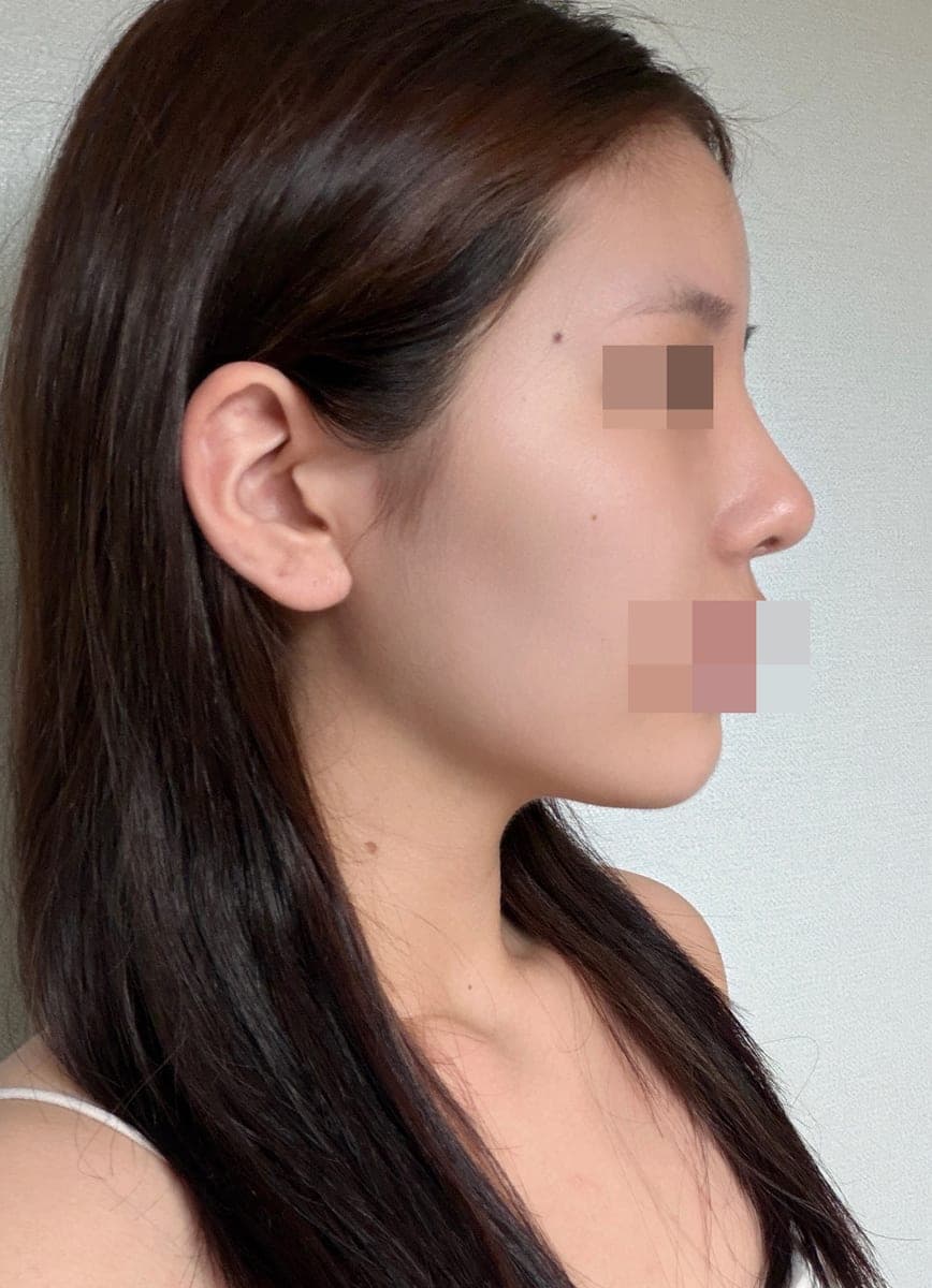Tip plasty with own cartilage
