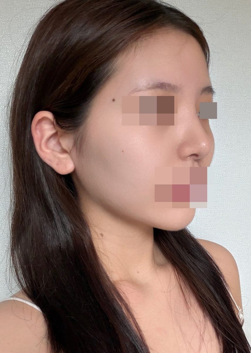 Tip plasty with own cartilage