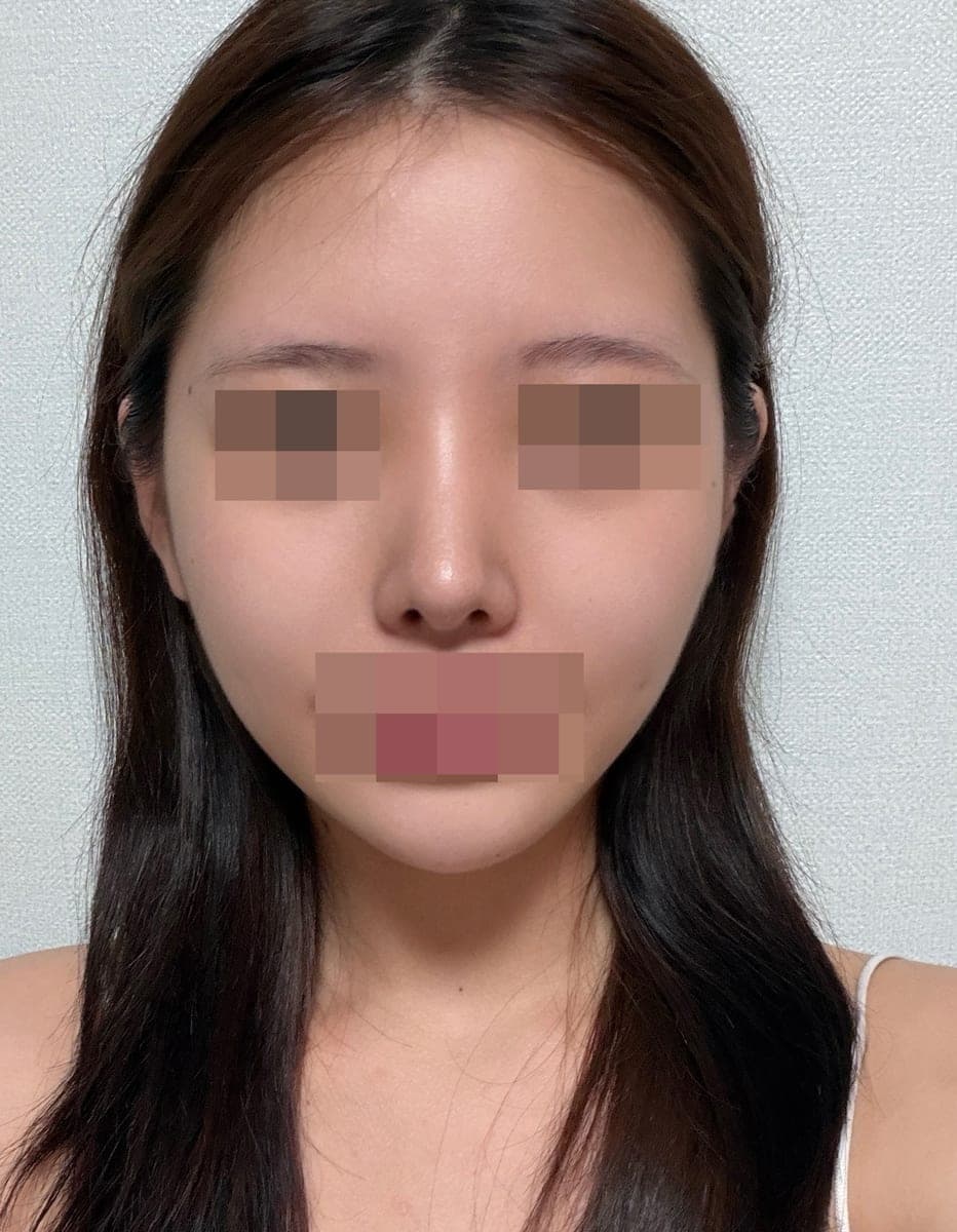 Tip plasty with own cartilage
