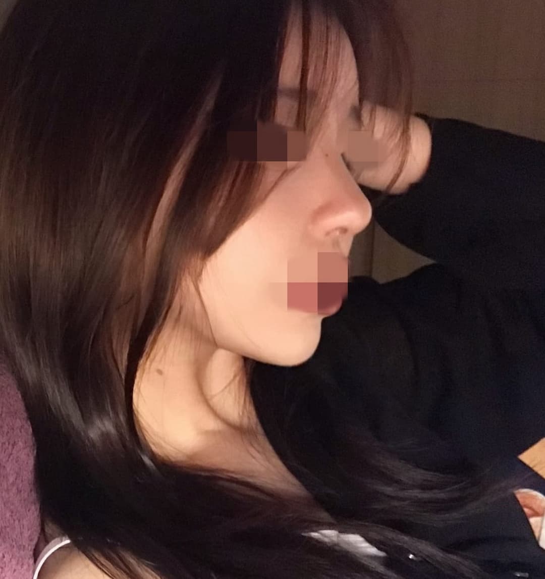 Tip plasty with own cartilage