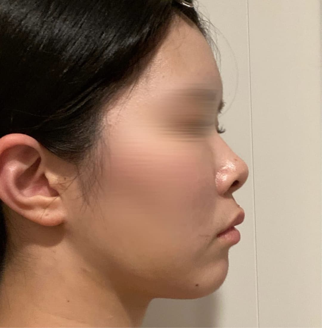 Narrowing a round tip with donor cartilage