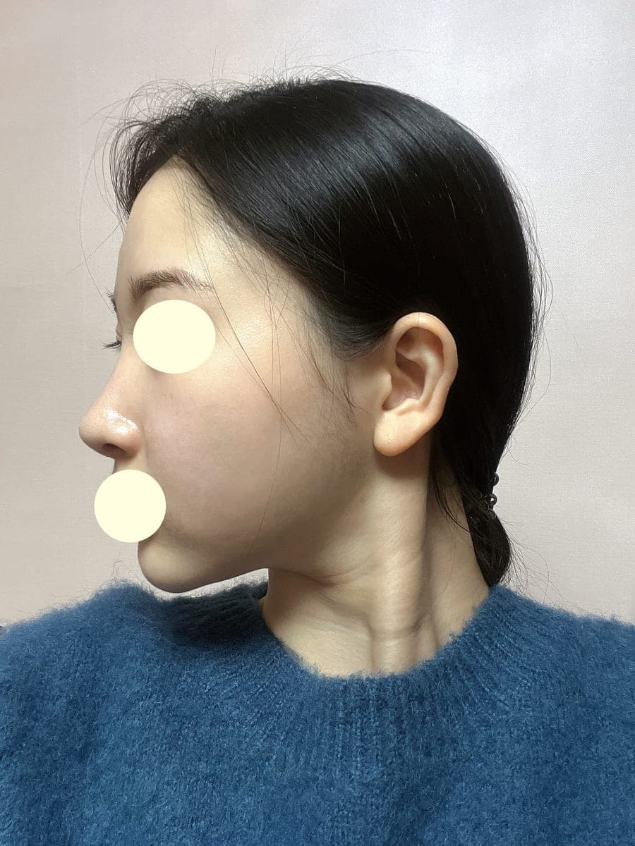 Implant removed, rebuilt with own cartilage