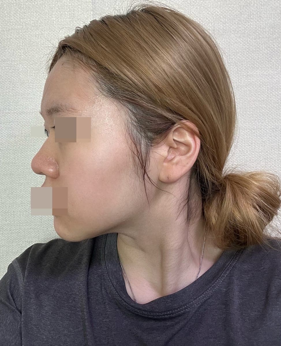 Building the tip with own cartilage