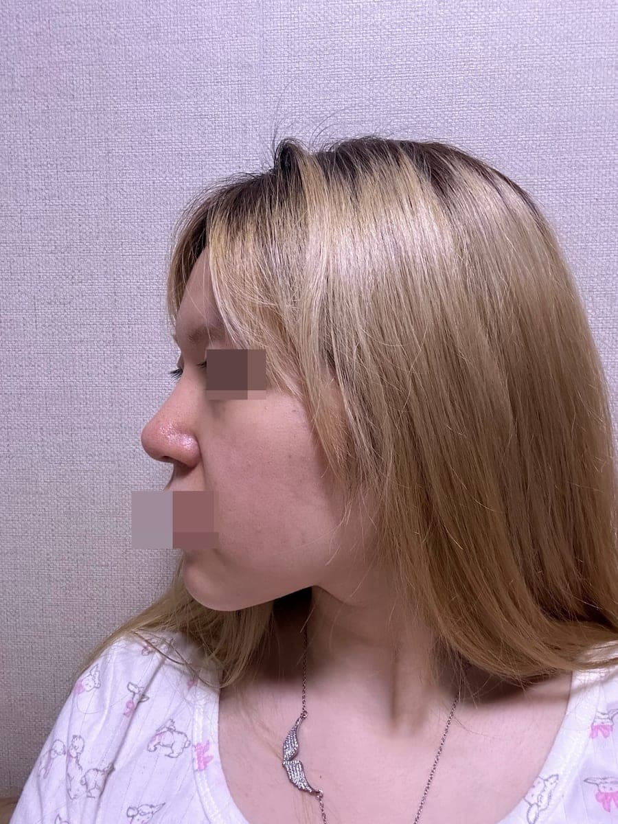 Building the tip with own cartilage