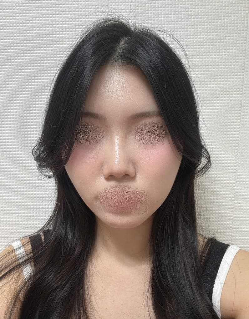 Reshaping the profile line + osteotomy