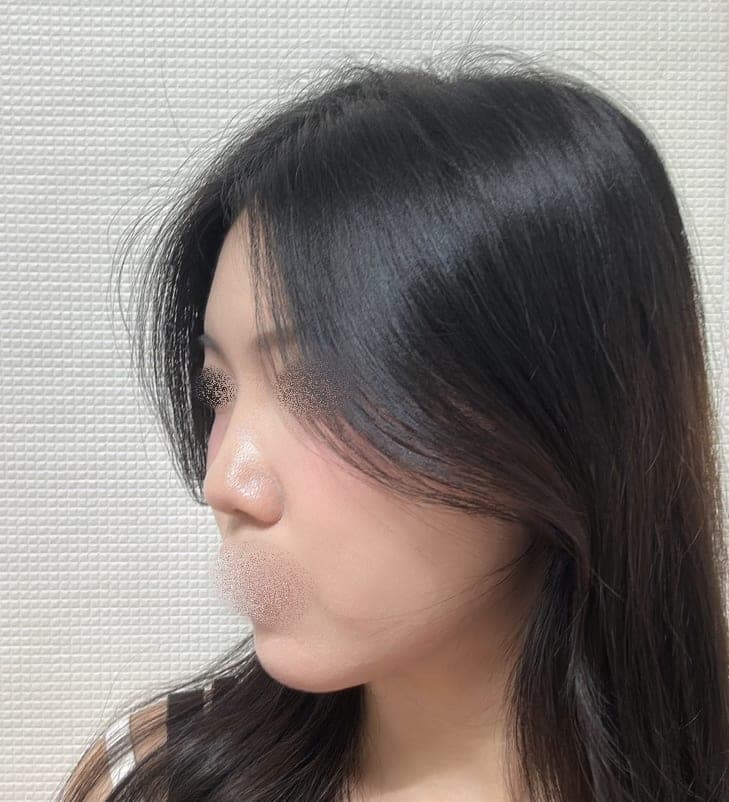Reshaping the profile line + osteotomy