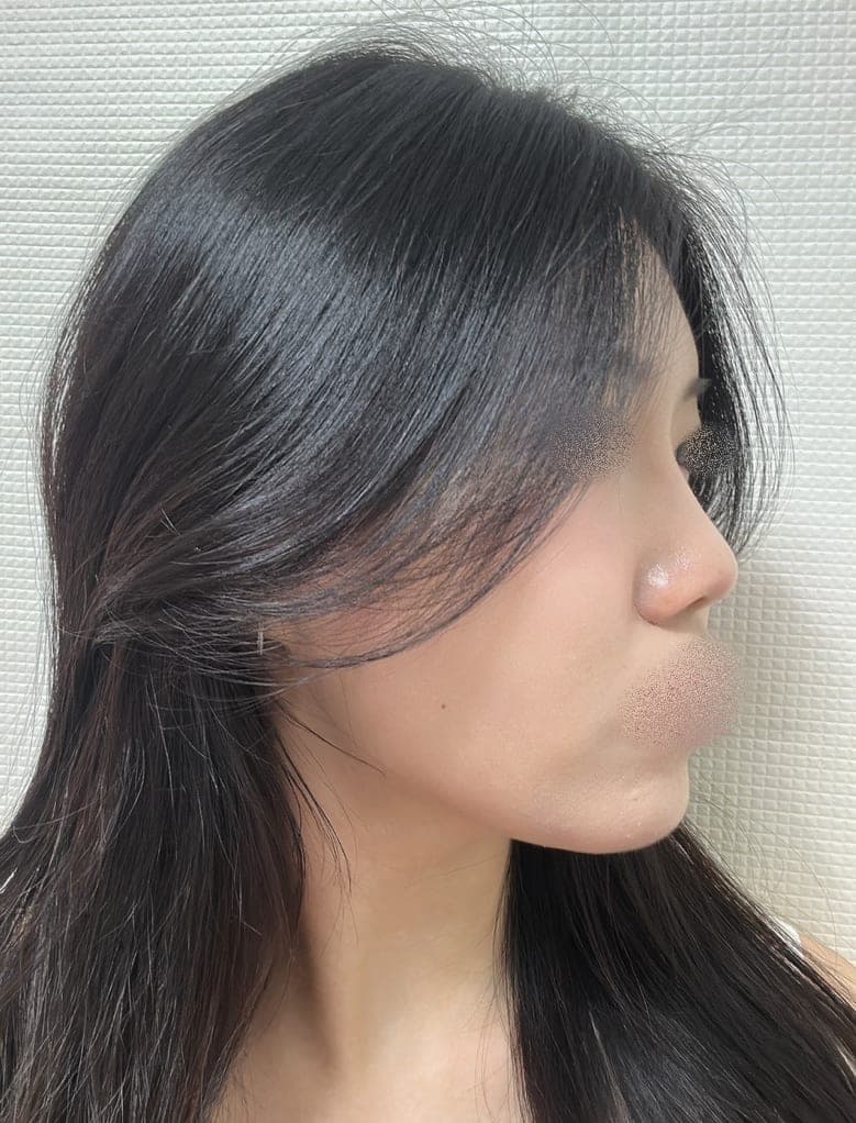 Reshaping the profile line + osteotomy