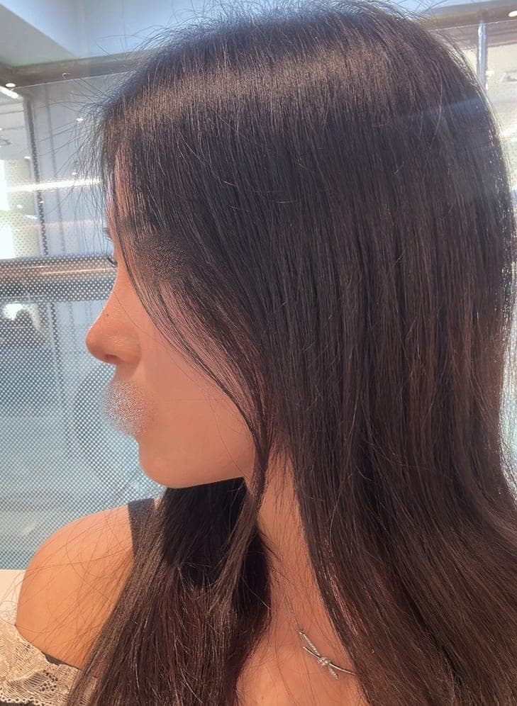 Reshaping the profile line + osteotomy