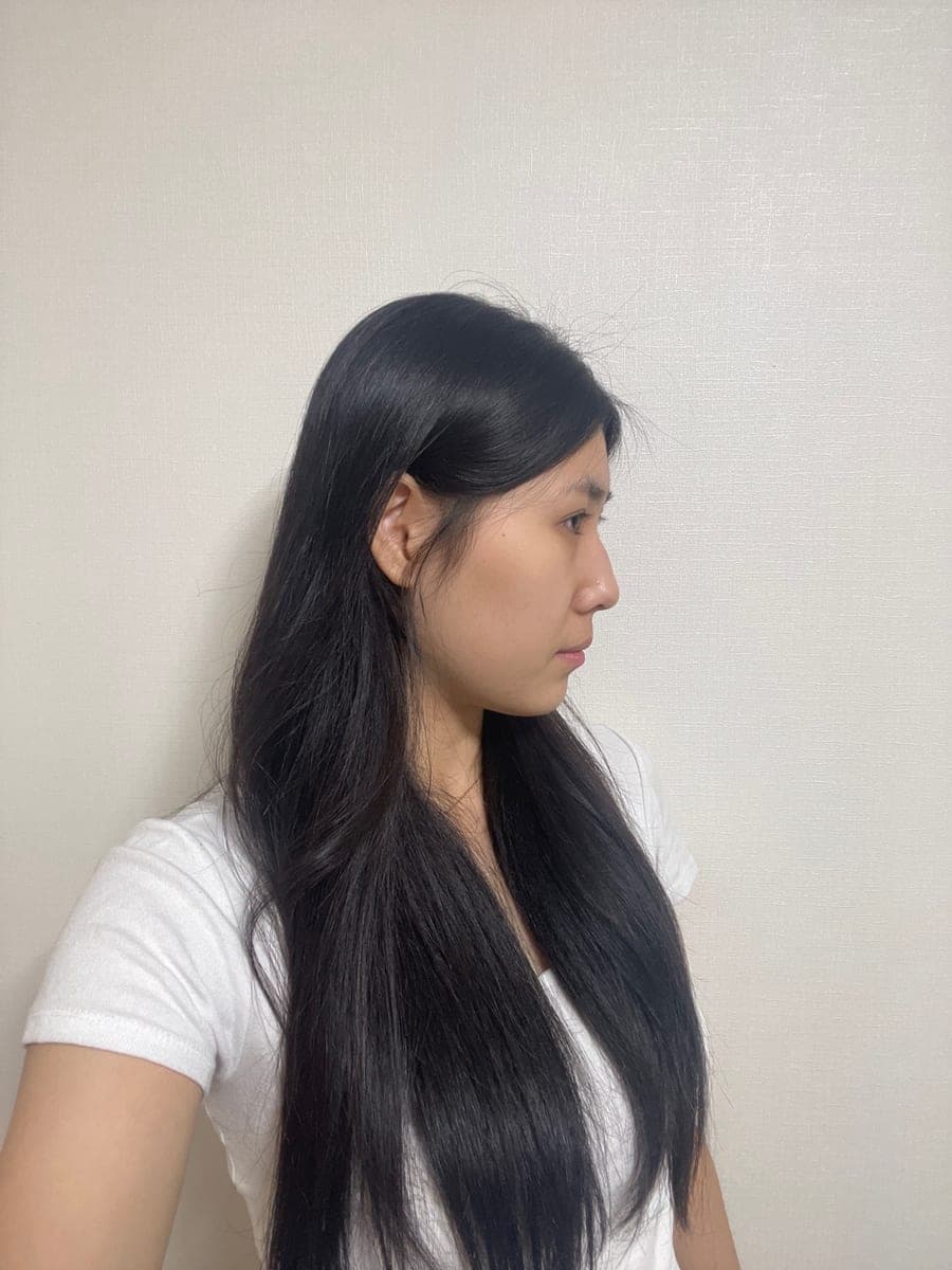 Smoothing a protruding bridge with own cartilage