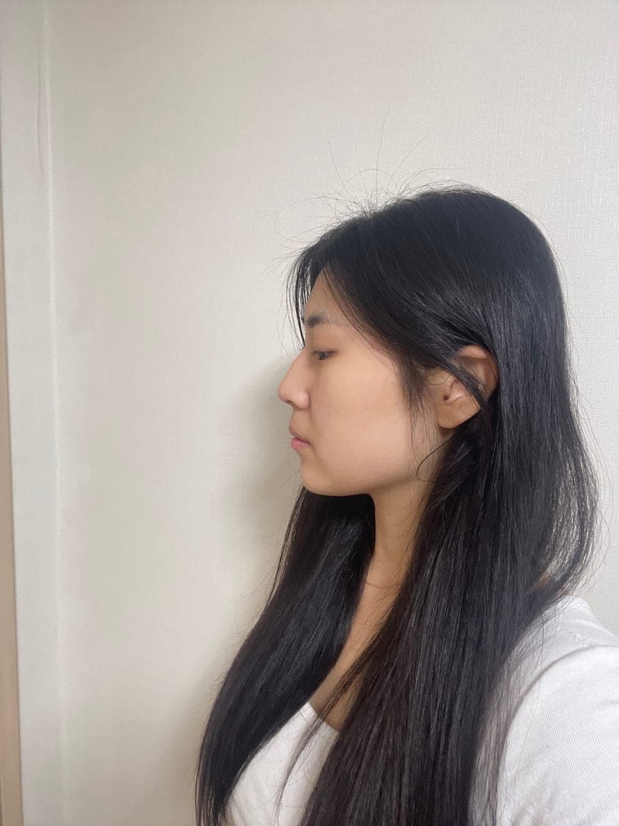 Smoothing a protruding bridge with own cartilage