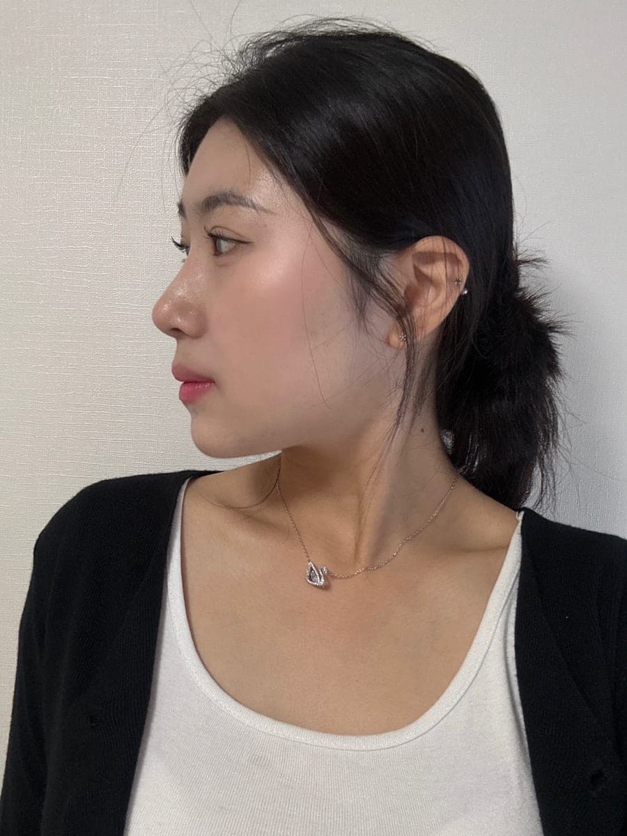 Smoothing a protruding bridge with own cartilage