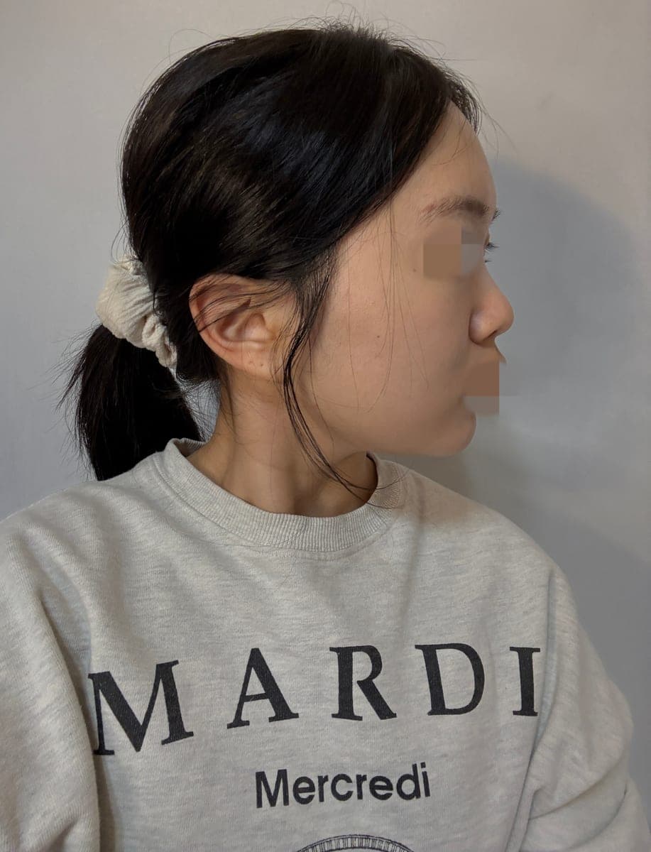 Tip only, with donor cartilage