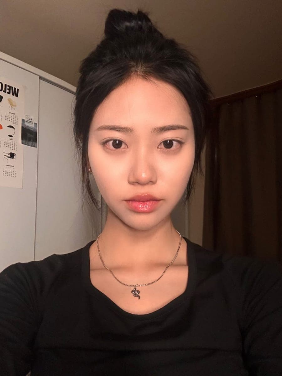 Bridge raised with own cartilage
