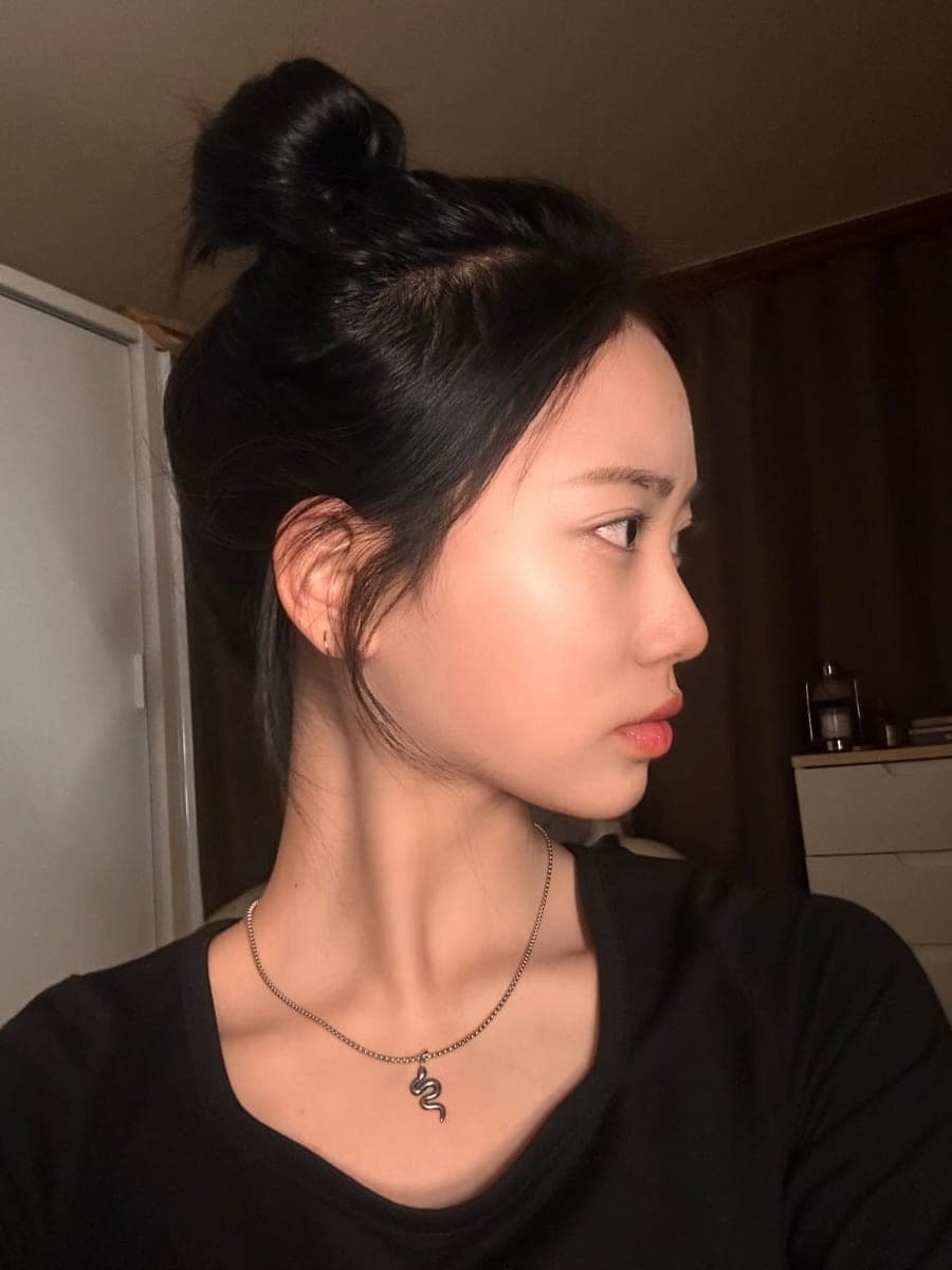 Bridge raised with own cartilage