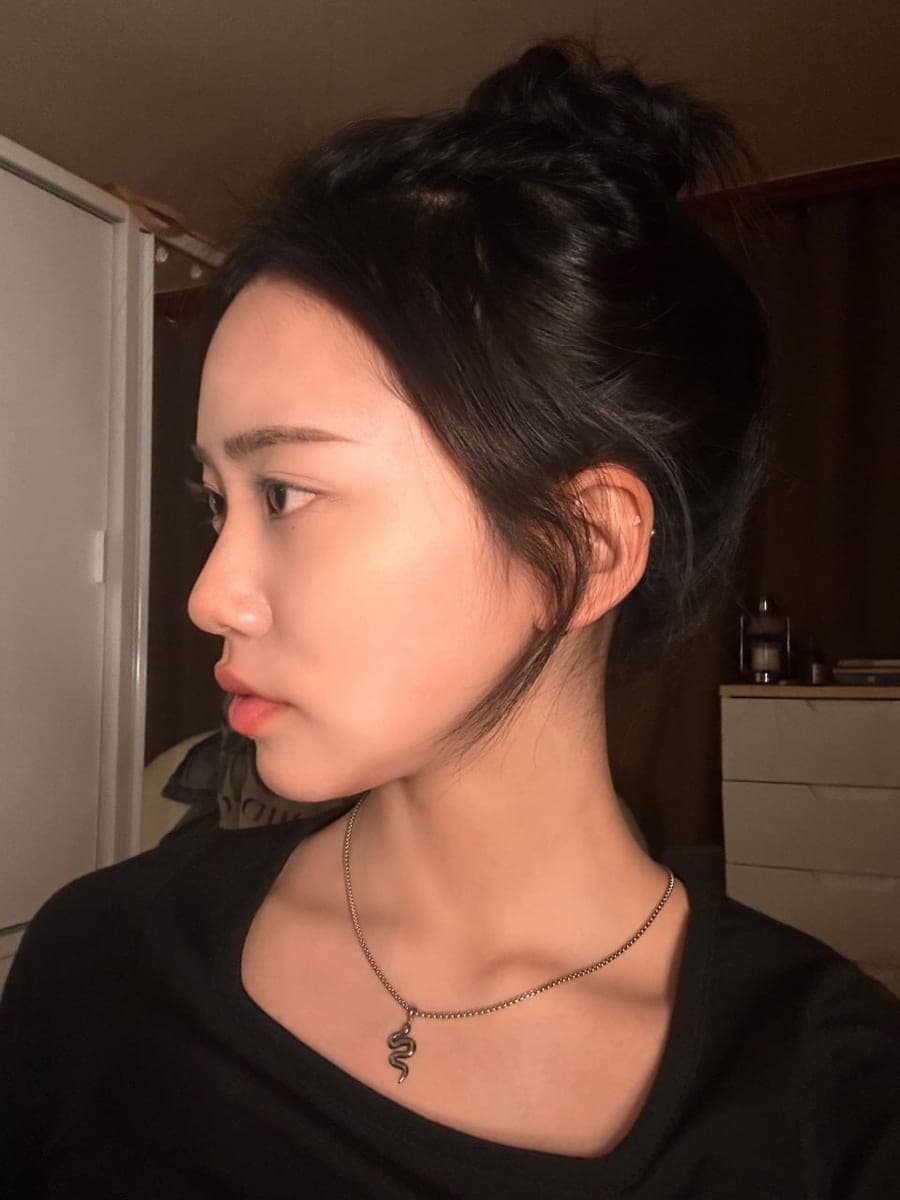 Bridge raised with own cartilage