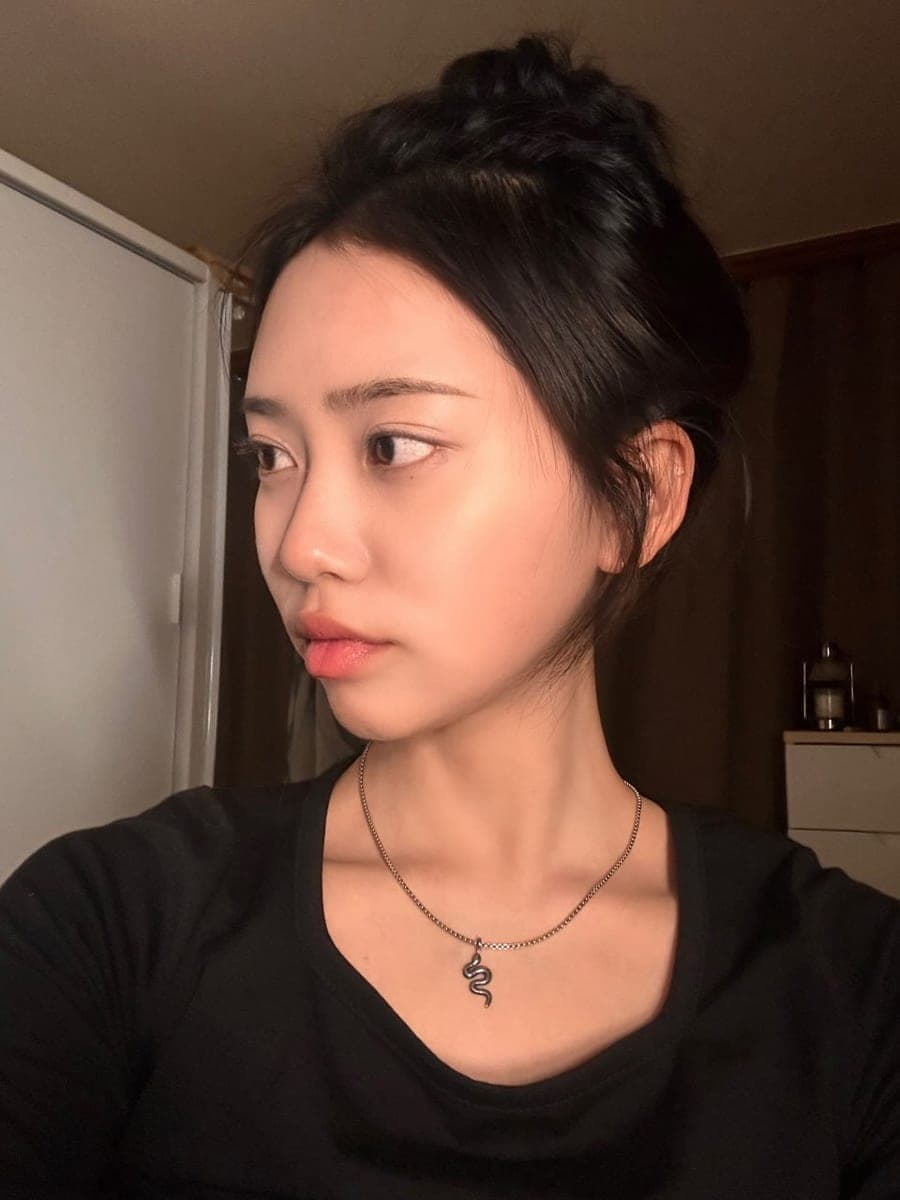 Bridge raised with own cartilage