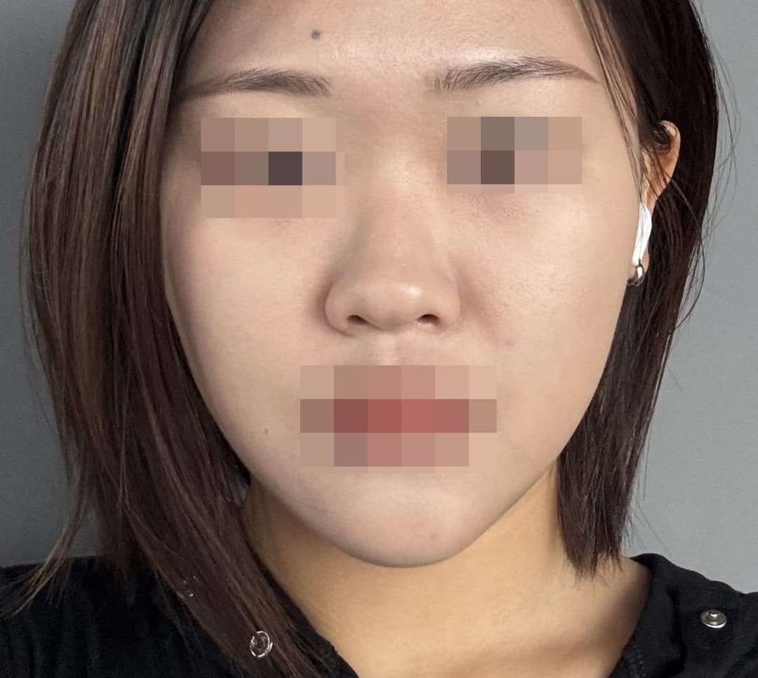 Bulbous tip and nose tip refined together