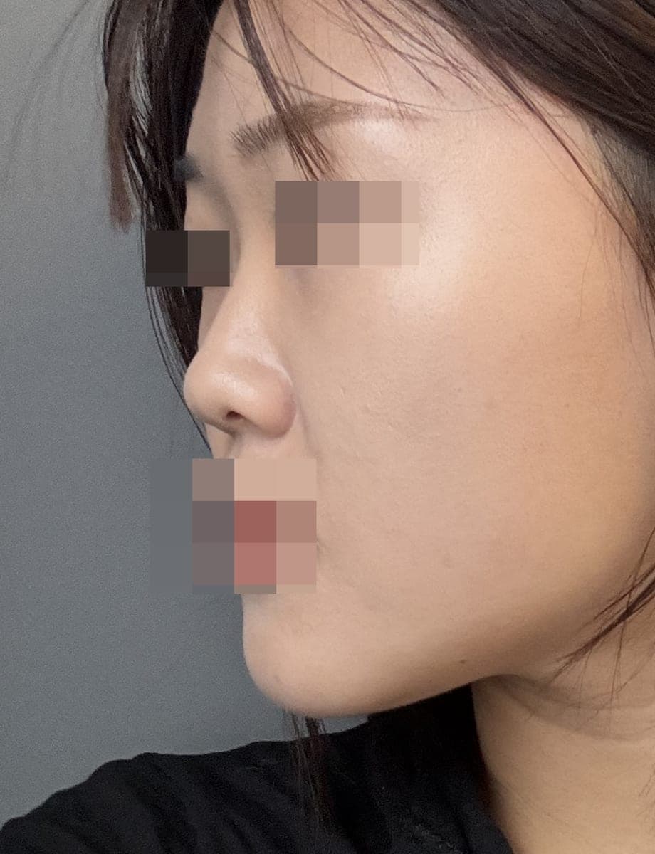 Bulbous tip and nose tip refined together