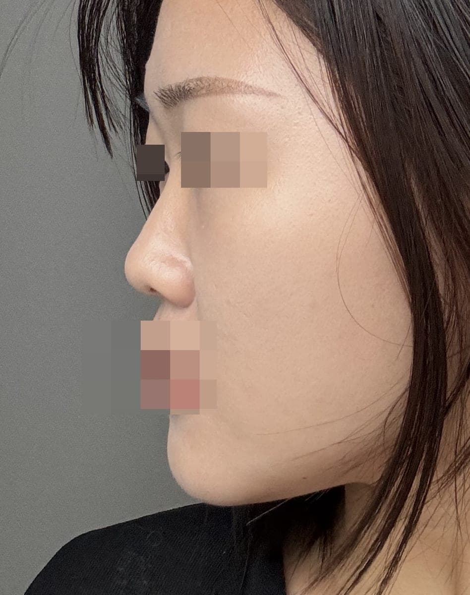 Bulbous tip and nose tip refined together