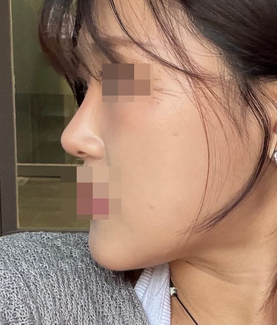 Bulbous tip and nose tip refined together