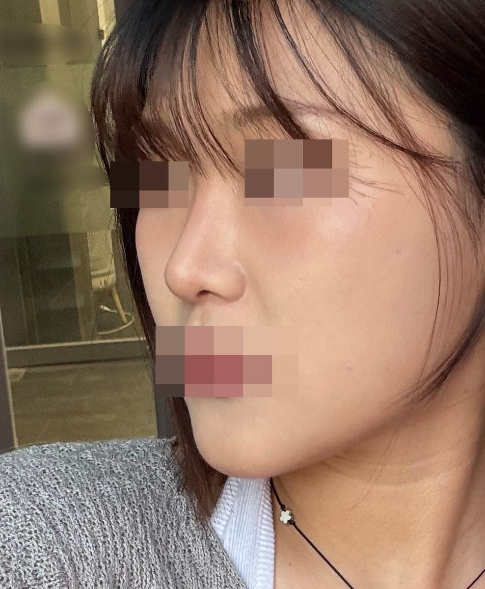 Bulbous tip and nose tip refined together