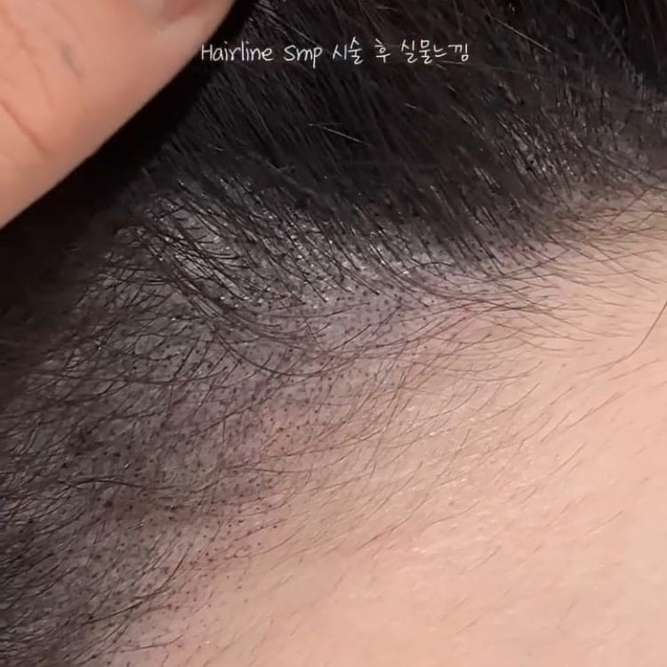 가까이서 본 헤어라인 SMP