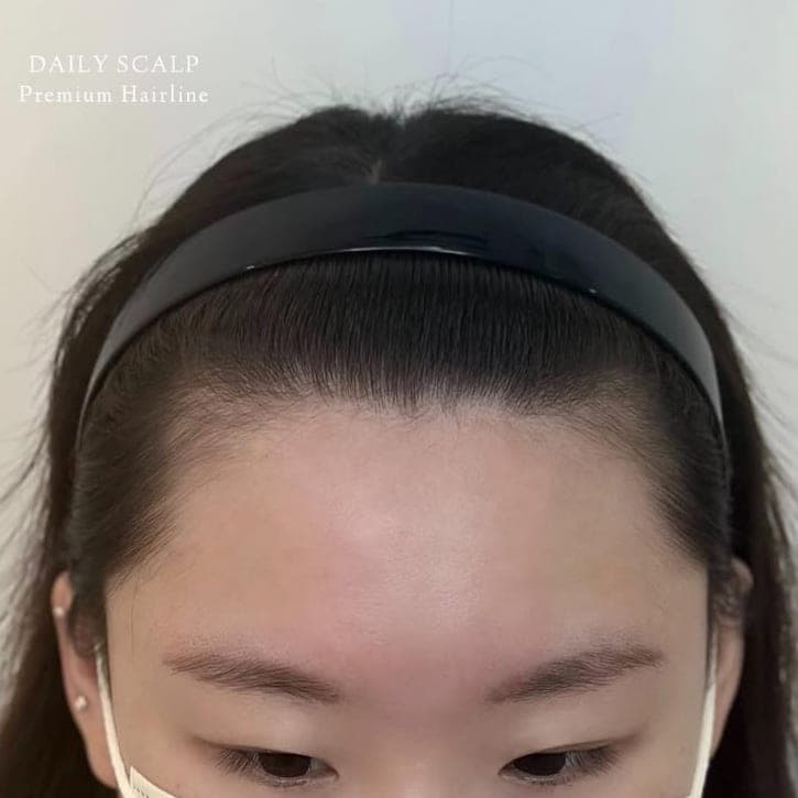 앞머리 라인을 정리한 헤어라인 SMP