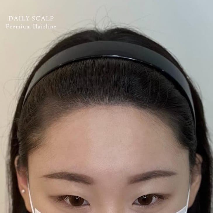 앞머리 라인을 정리한 헤어라인 SMP