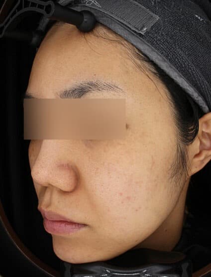 Black Toning — After treatment
