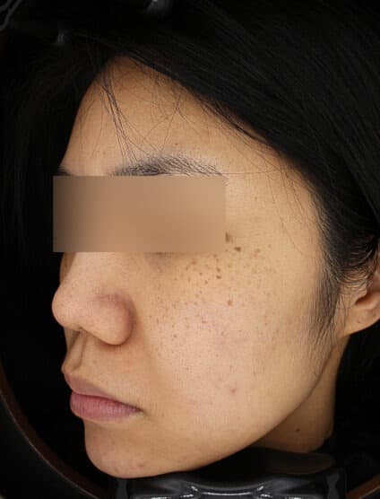 Black Toning — Before treatment