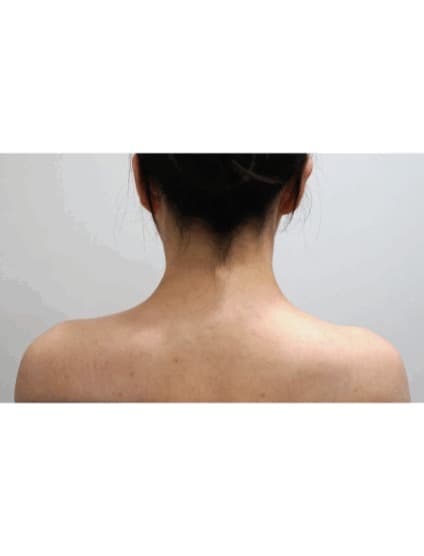 Trapezius botulinum toxin injection — After treatment