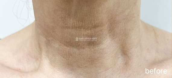 Neck wrinkle filler — Before treatment