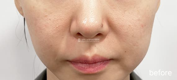 Juvelook Volume — Before treatment