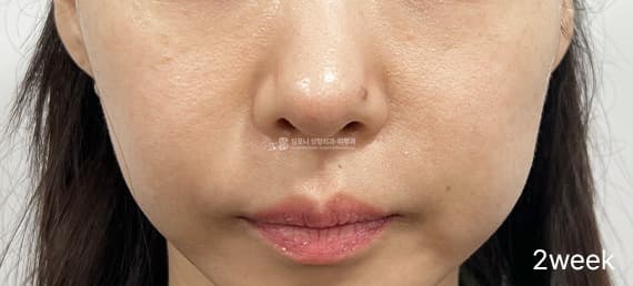 Juvelook Volume — After treatment