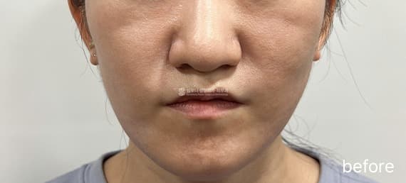 Juvelook Volume — Before treatment