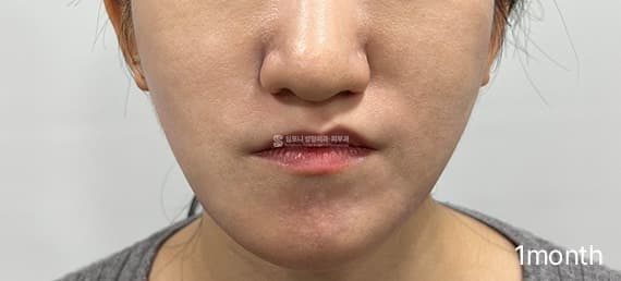 Juvelook Volume — After treatment