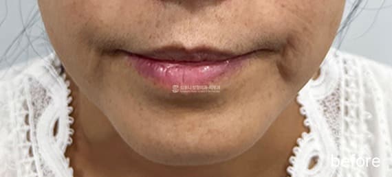 Thermajet (Thermage, Mirajet, and Juvelook) — Before treatment