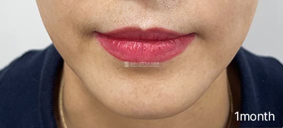 Thermajet (Thermage, Mirajet, and Juvelook) — After treatment