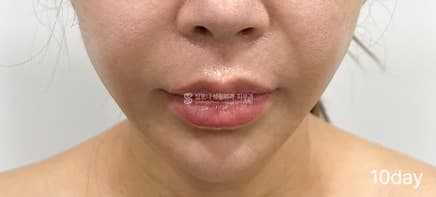 Ultherajet — After treatment