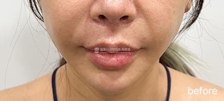 Ultherajet — Before treatment
