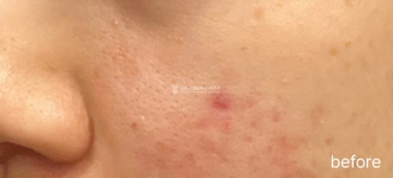 Mirajet and Exosome application — Before treatment