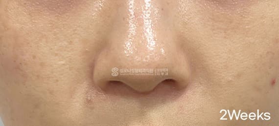 Mirajet and Rituo — After treatment