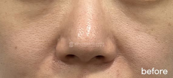 Mirajet and Rituo — Before treatment