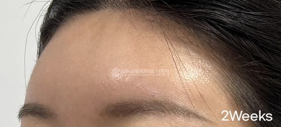 Filler and Botox — After treatment