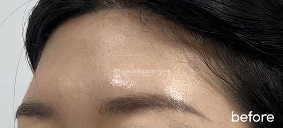 Filler and Botox — Before treatment