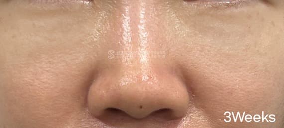 ReTuo — After treatment