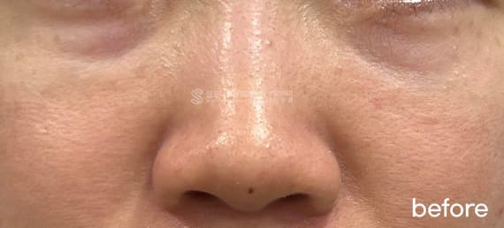 ReTuo — Before treatment