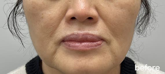 Sofwave, Thermage, Radiesse, and Botox — Before treatment
