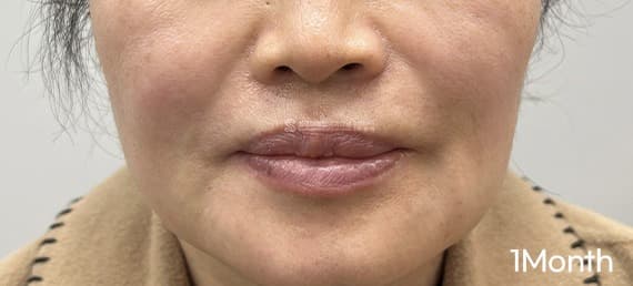 Sofwave, Thermage, Radiesse, and Botox — After treatment